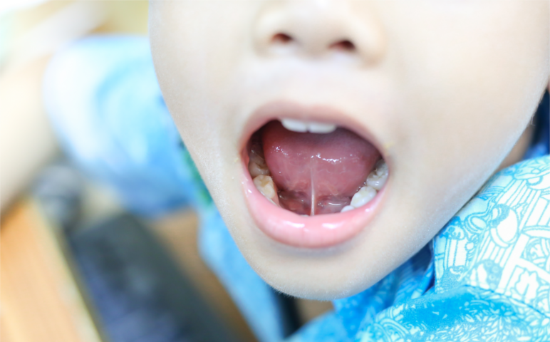 Tongue-Tie and Myo-Functional Therapy at Montrose Dental