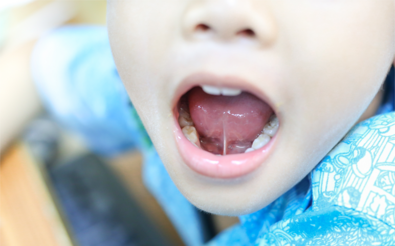 Tongue-tie release at Montrose Dental