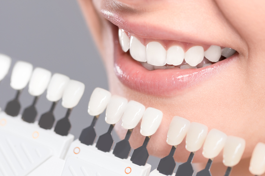 Teeth Whitening at Montrose Dental